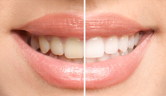 Close up of a person's smile before and after teeth whitening