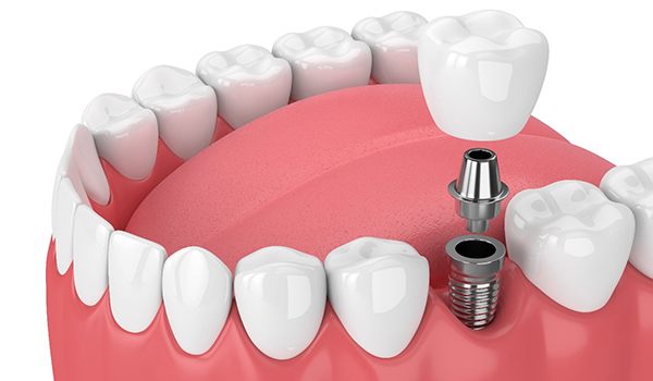Animated dental crown, abutment, and dental implant replacing a missing tooth