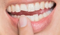 Close up of a smile with a chipped tooth