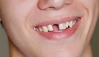Close up of a smile with a missing tooth