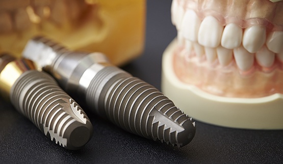 Model of the teeth lying on a flat surface next to dental implant posts