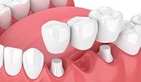 Animated dental bridge supported by two dental implants replacing three missing teeth