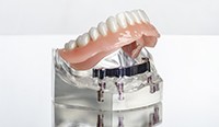 Model of an implant denture replacing a full arch of missing teeth