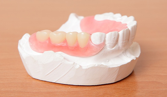 Partial denture on a model of the lower arch of teeth