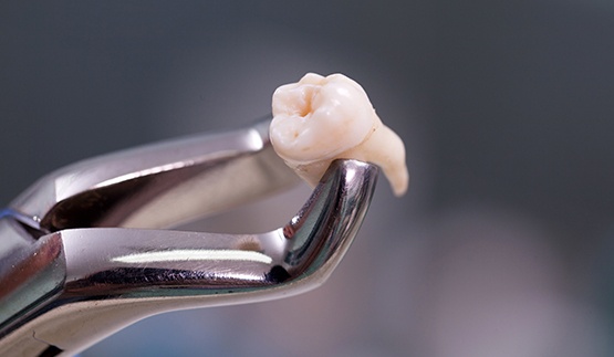Clasp holding extracted wisdom tooth in Collinsville