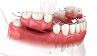 Picture of a partial denture